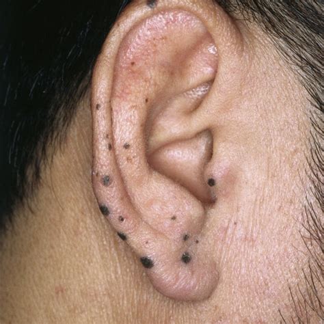 Polychondritis Recidivans Visible Deformity Of The Ears Cartilage