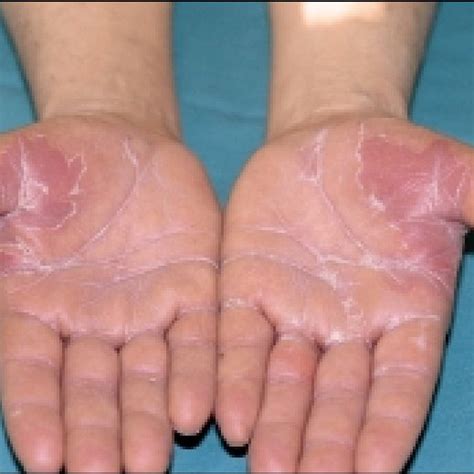 Palmar Edema Erythema And Blisters In The Lateral Aspects Of The
