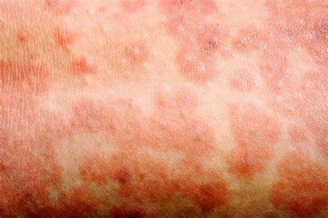 Measles Symptoms Nhs