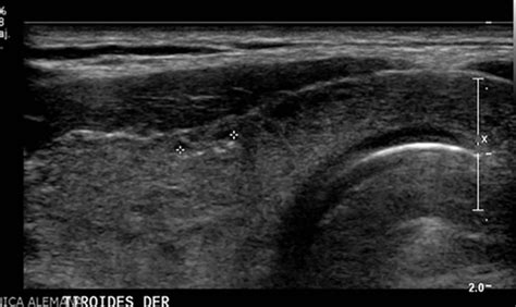 Thyroid Microcalcifications In The Absence Of Identifiable Nodules And