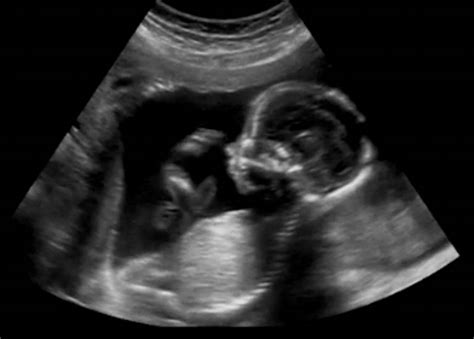 Pregnancy Ultrasounds Week By Week
