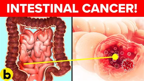 8 Signs Of Intestinal Cancer That You Should Be Aware Of Youtube