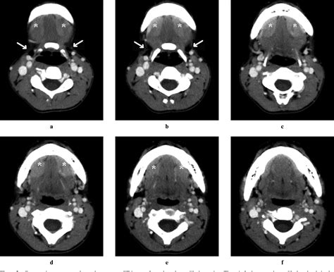 Figure 2 From Ct And Mr Findings Of Bilateral Submandibular Gland