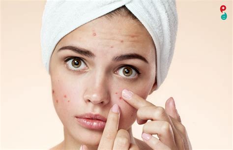 Pimple Treatment How To Find The Best Pimple Treatment Mppres