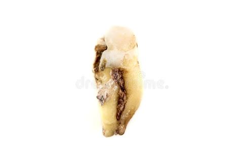 Decayed Wisdom Tooth Stock Image Image Of Medicine 140222319