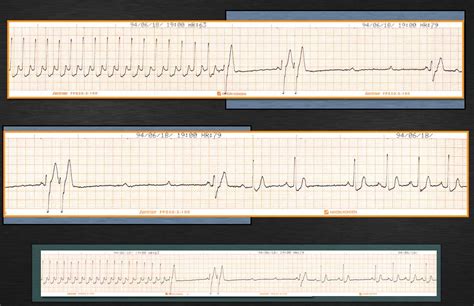 Paroxysmal supraventricular tachycardia (svt, psvt). ECG-045：answer: Cardio2012のECGブログ
