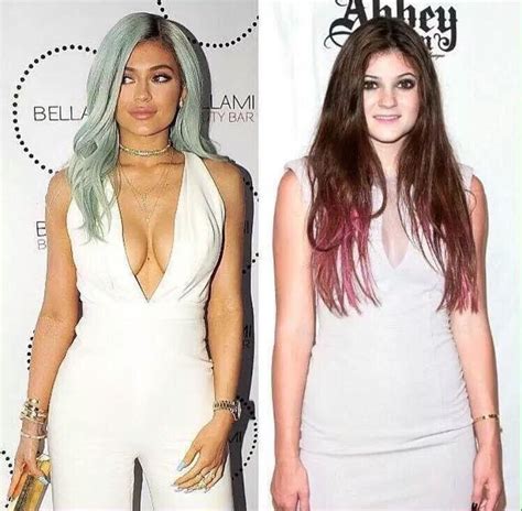 Kylie Jenner before and after | Celebs, Plastic surgery, Kylie