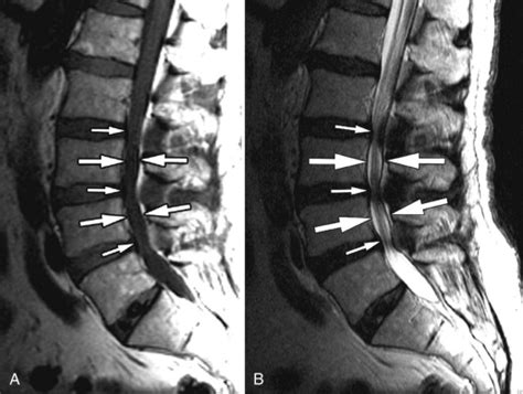 Spinal Stenosis Lumbar Radiology Key