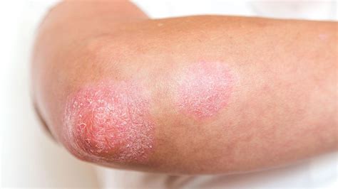 Psoriasis Types Plaque Guttate More Everyday Health