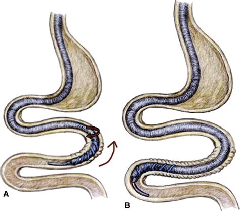 Figure 3 From Spiral Enteroscopy A Novel Method Of Enteroscopy By