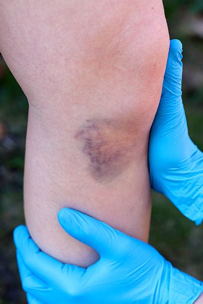 Top Bruised Knee Stock Photos Pictures And Images Istock