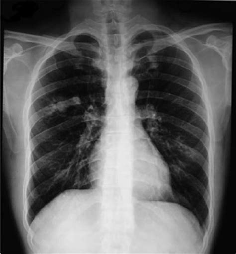 Scegli uno specialista che se ne occupa e prenota una visita. Chest radiograph showing a non-homogeneous opacity in the ...