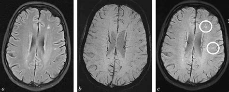 Brain Mri Scan From A Patient With Ms In Flair A And Swi B Modes