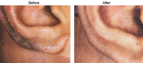 Laser hair removal, medical spas, dermatologists. Laser Hair Removal Beverly Hills, Los Angeles