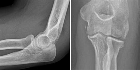 Anteroposterior And Lateral Radiographs Of The Injured Elbow Showing An