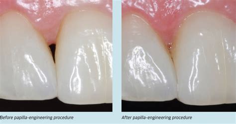 Treating Black Triangles With Dermal Fillers Periodontist In