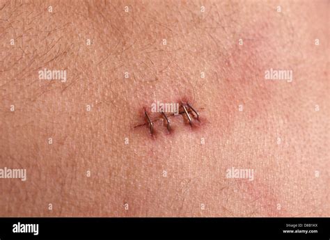 Operation Wound Hi Res Stock Photography And Images Alamy