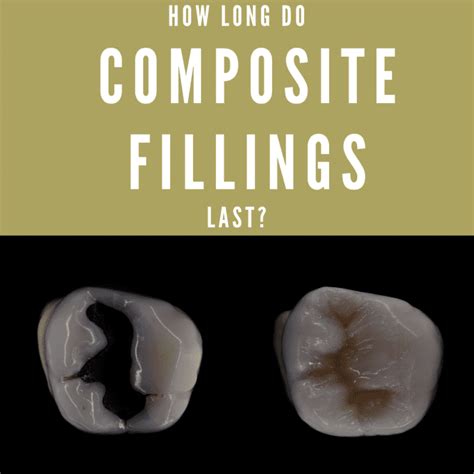 Belotero offers a wide range of different cosmetic dermal fillers. How Long Do Composite Fillings Last? | Southwest Family ...