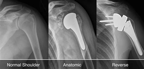 Shoulder Replacement Laud Clinic