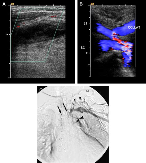 Upper Extremity Venous Doppler Ultrasound Radiologic Clinics