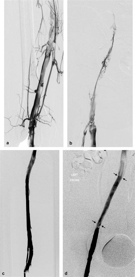 Single Session Pharmacomechanical Catheter Directed Thrombolysis Using