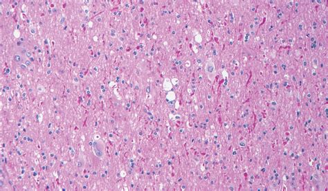 Ganglioglioma Childrens Brain Tumor Network