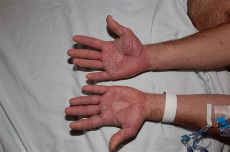 Stevens Johnson Syndrome Hands