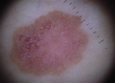 Dermoscopy Of Clonal Seborrheic Keratosis Journal Of The American