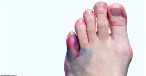 Why Are My Feet Purple 7 Causes Of Foot Discoloration You Should Know About Purple Feet