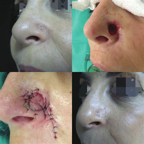 Basal Cell Carcinoma Bcc Chirurgie Plastica Si Estetica Chirurgie My