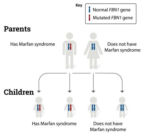 Marfan Syndrome Nhlbi Nih