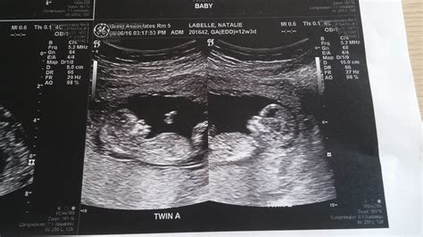 13 Weeks Pregnant Ultrasound Twins