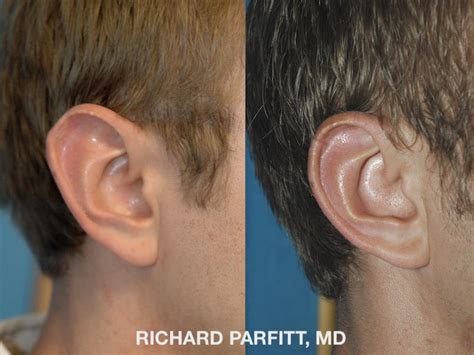 Ear Surgery Otoplasty Photos Dr Richard Parfitt