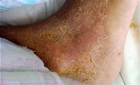 Norwegian Scabies The Hku E Learning Platform In Clinical Medicine