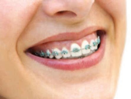 We did not find results for: Harga Pasang Kawat Gigi/Behel | Seo Edan