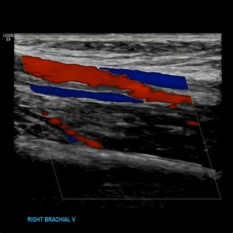Upper Extremity Venous Doppler Sonographic Tendencies Vascular Ultrasound Brachial Vein