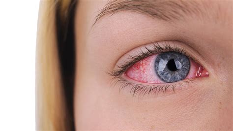 Texas Doctor Warns Super Strain Of Pink Eye On Rise In Part Of State