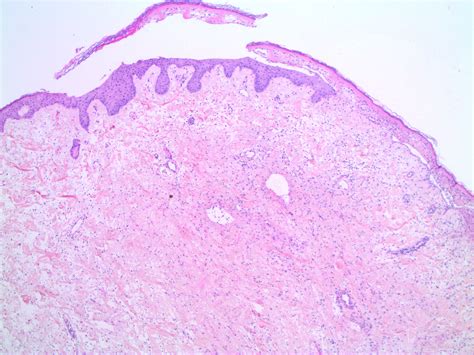Fibroepithelial Polyp Histology