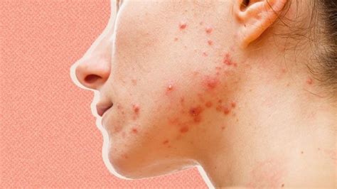 Can Hypothyroidism Cause Acne Problems