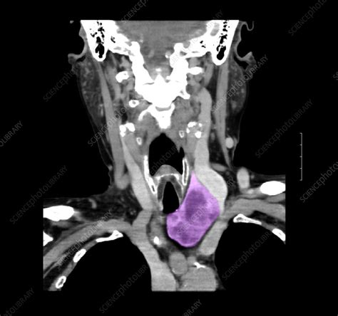 Ct Of Neck Showing Thyroid Goiter Stock Image F0319894 Science