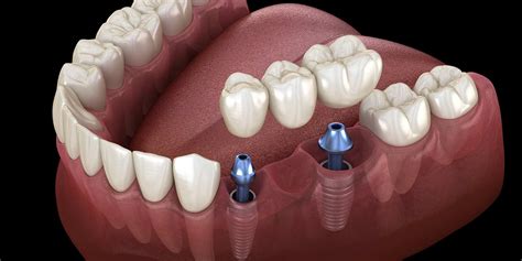 How Do You Know Which Dental Implants Are Right For You