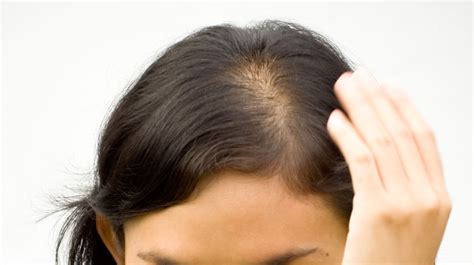 Hair Loss Alopecia The London Dermatologist