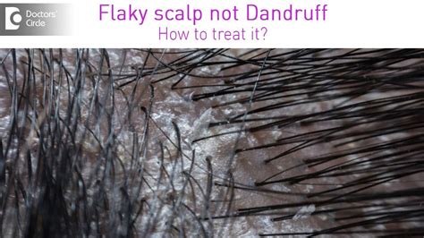 Get Rid Of Itchy White Flaky Scalp Which Is Not Dandruff Dr Rashmi