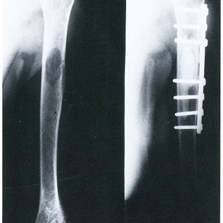(PDF) Treatment of pathological fractures of the humeral ...