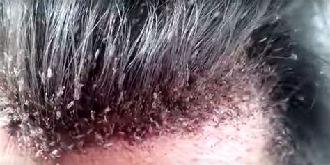 This head lice infestation video is so gross you shouldn't ...