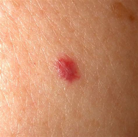 Cherry Angioma Current Health Advice Health Blog Articles And Tips