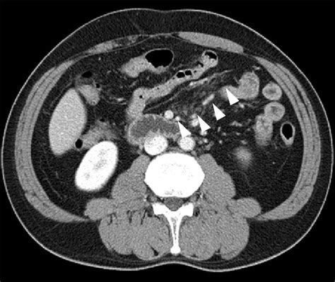 Abdominal Ct Findings Abdominal Ct Scan Revealed Haziness In The
