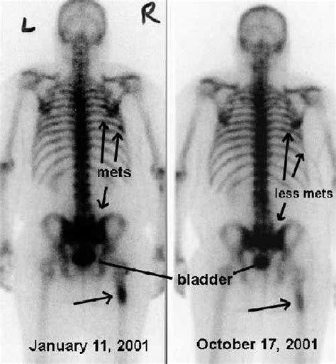 Bone Scans Encognitivecom