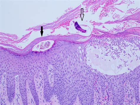 Histopathologic Examination Revealed A Scabetic Mite Within The Stratum