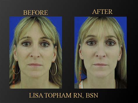 Restylane Injections Fairfield County Facial Fillers Split Rock